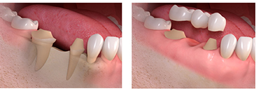 dental implant facial