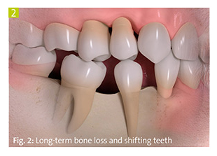 facial bone loss teeth