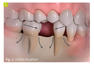 dental implant facial
