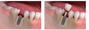 facial bone loss teeth