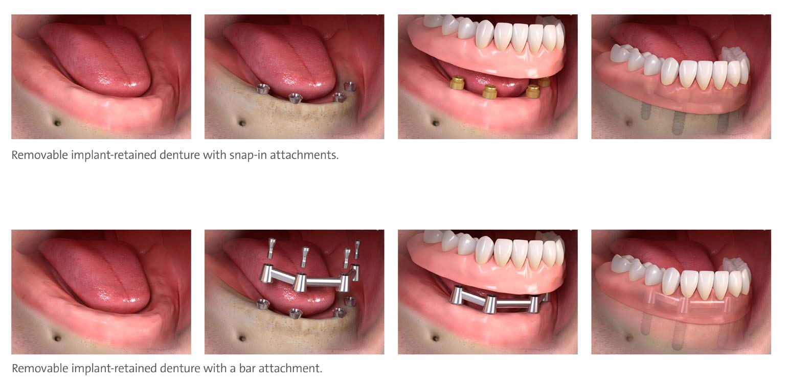 removable implant dentures