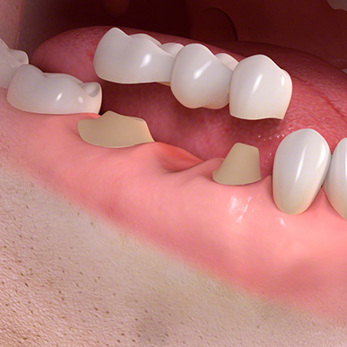 fixed partial denture