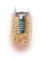 anchorage dental implant