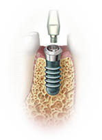 dental tooth implant