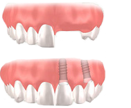 anchorage dental implant