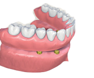 dental tooth implant