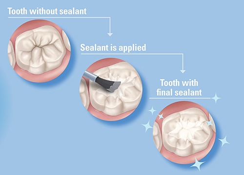 dental sealants anchorage
