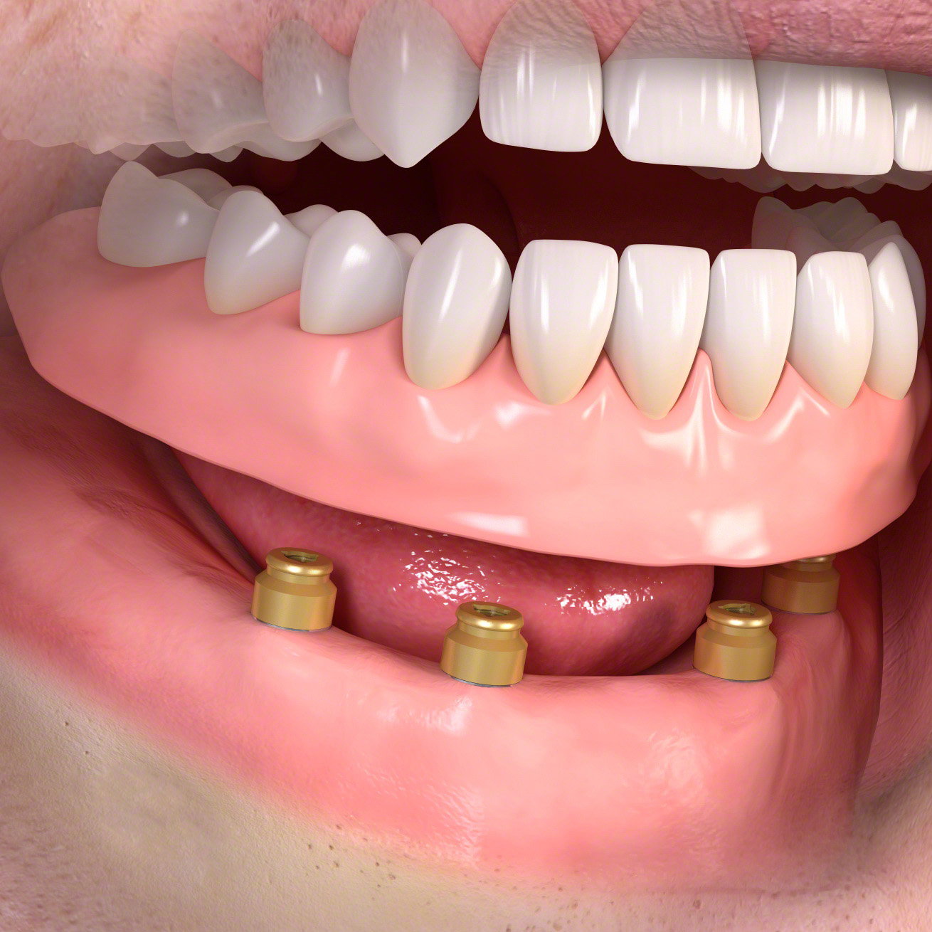 removable dental implants anchorage