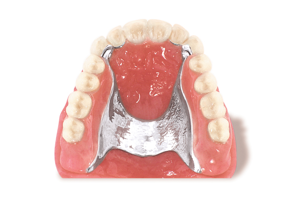 anchorage removable dentures partial