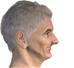 jaw with dental implant